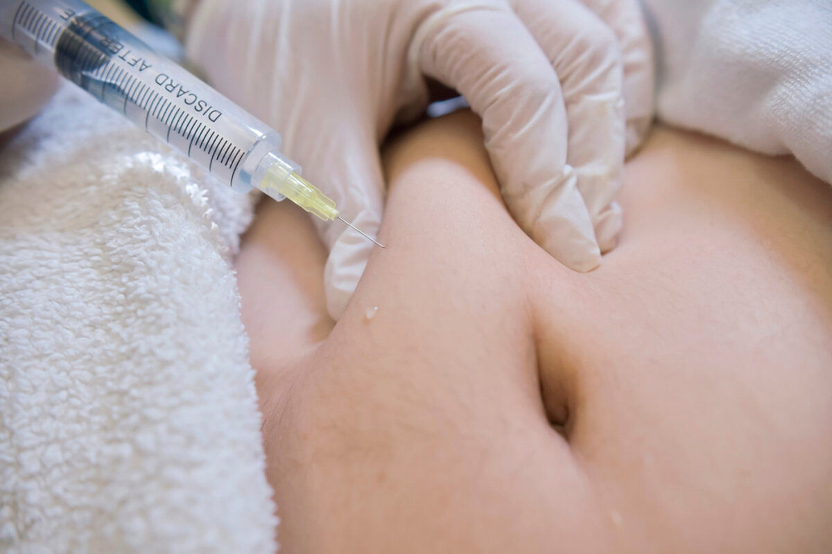 lams in korea - local anesthetic minimally invasive liposuction at 365mc in seoul, south korea